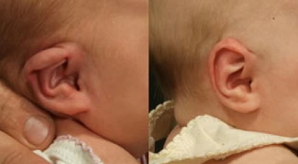 Before-and-after photos of baby's ear with the EarWell device.