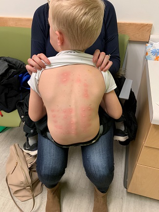 Logan's back after his allergy testing